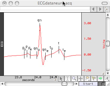 ECG Data with Markers